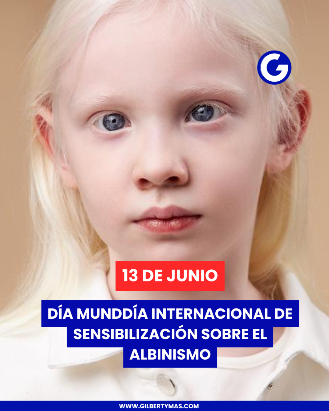 Día Internacional de Sensibilización sobre el Albinismo